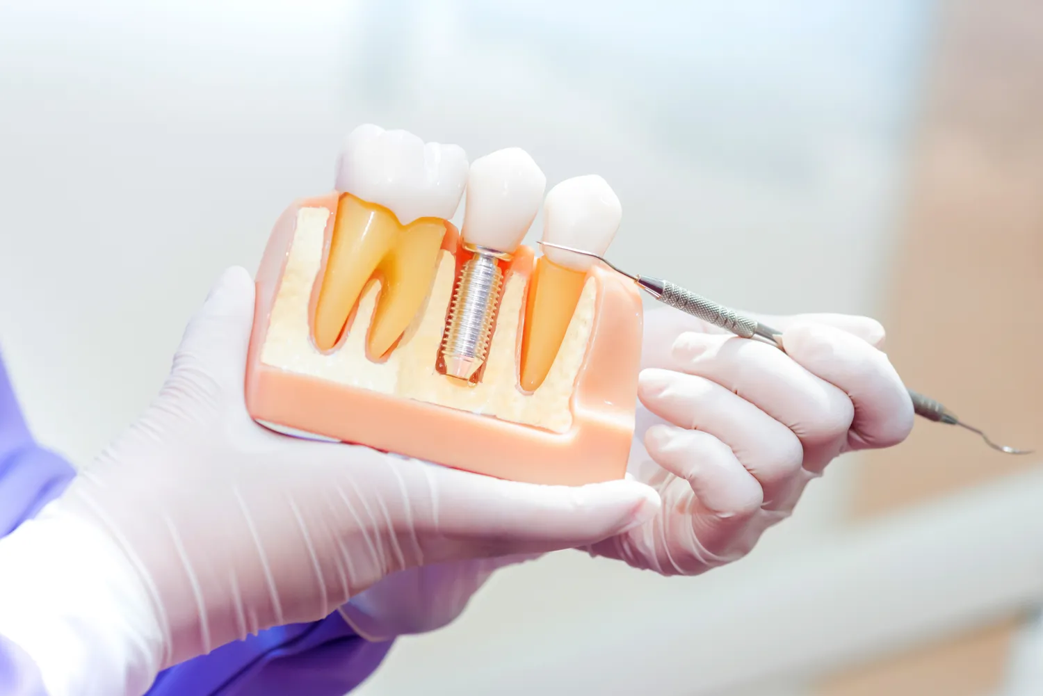 Jak wygląda zabieg wszczepiania implantów zębowych?