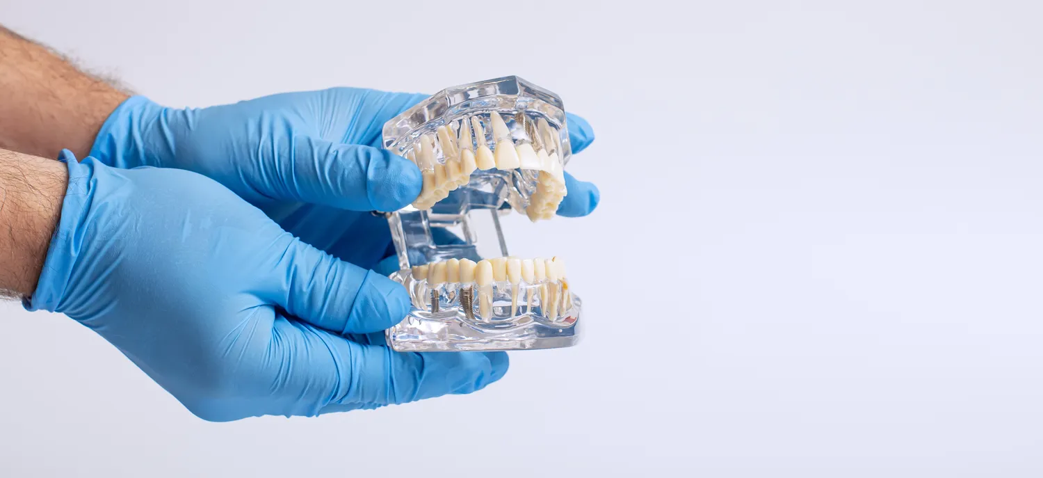 Rodzaje implantów zębowych
