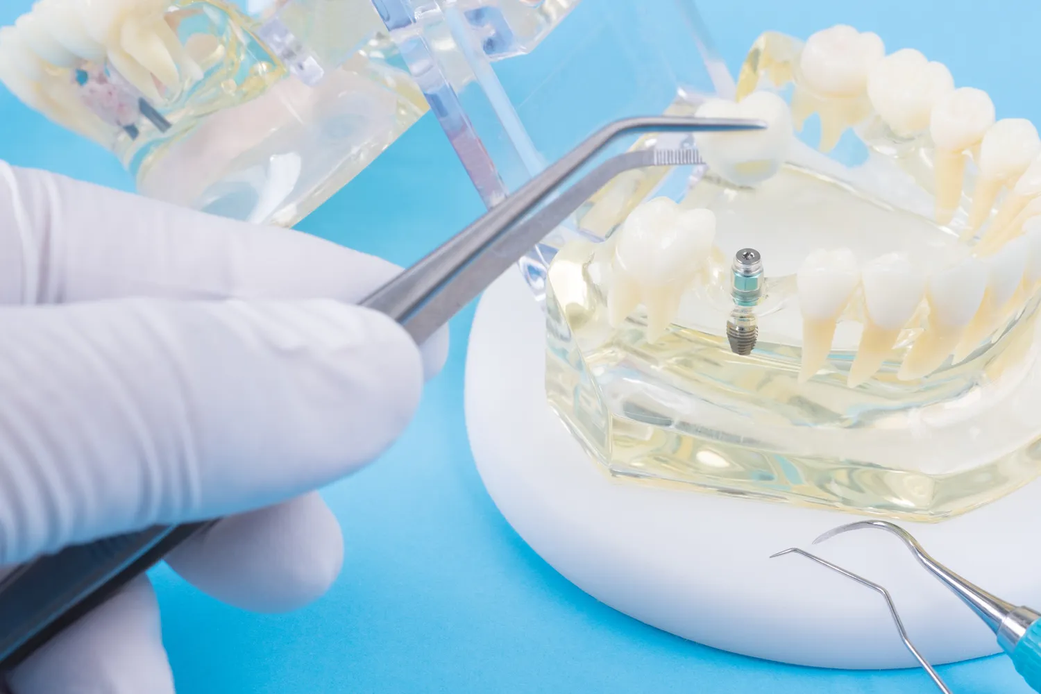 Implanty zębowe cena Lublin