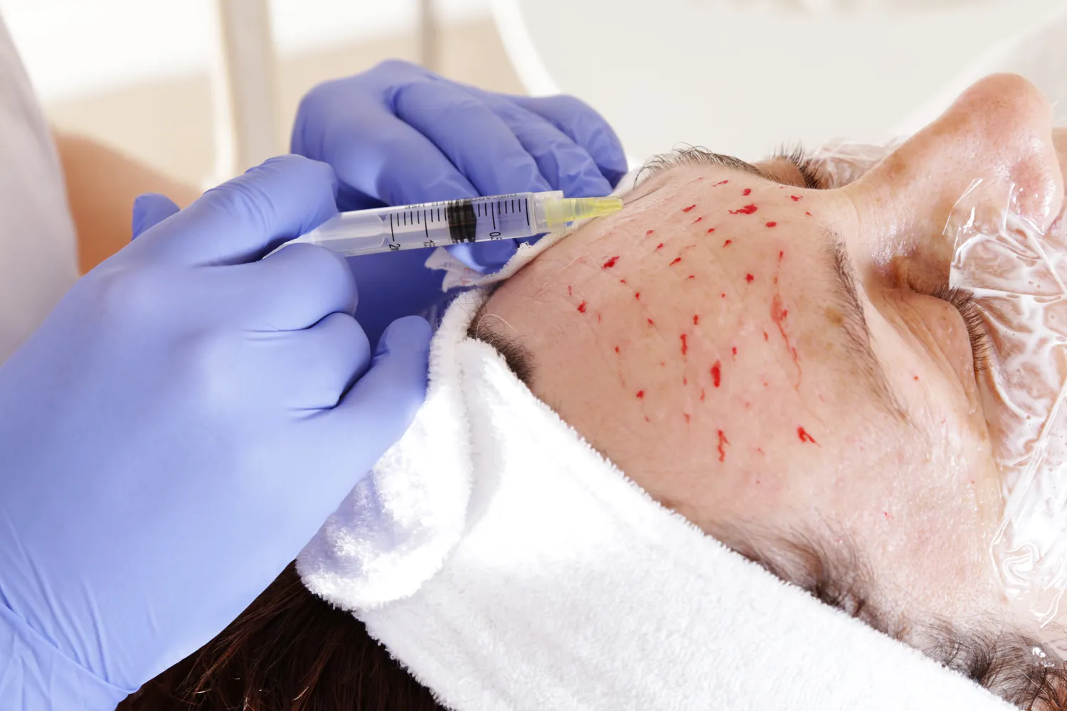 Jak długo układa się kwas hialuronowy w ustach?