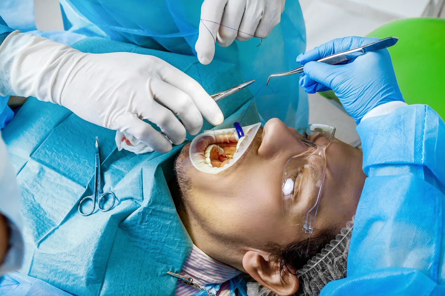 Ile trwa leczenie kanałowe 5?