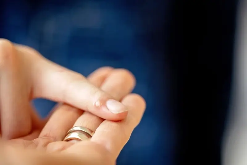 Ile trwa leczenie kurzajki na stopie?